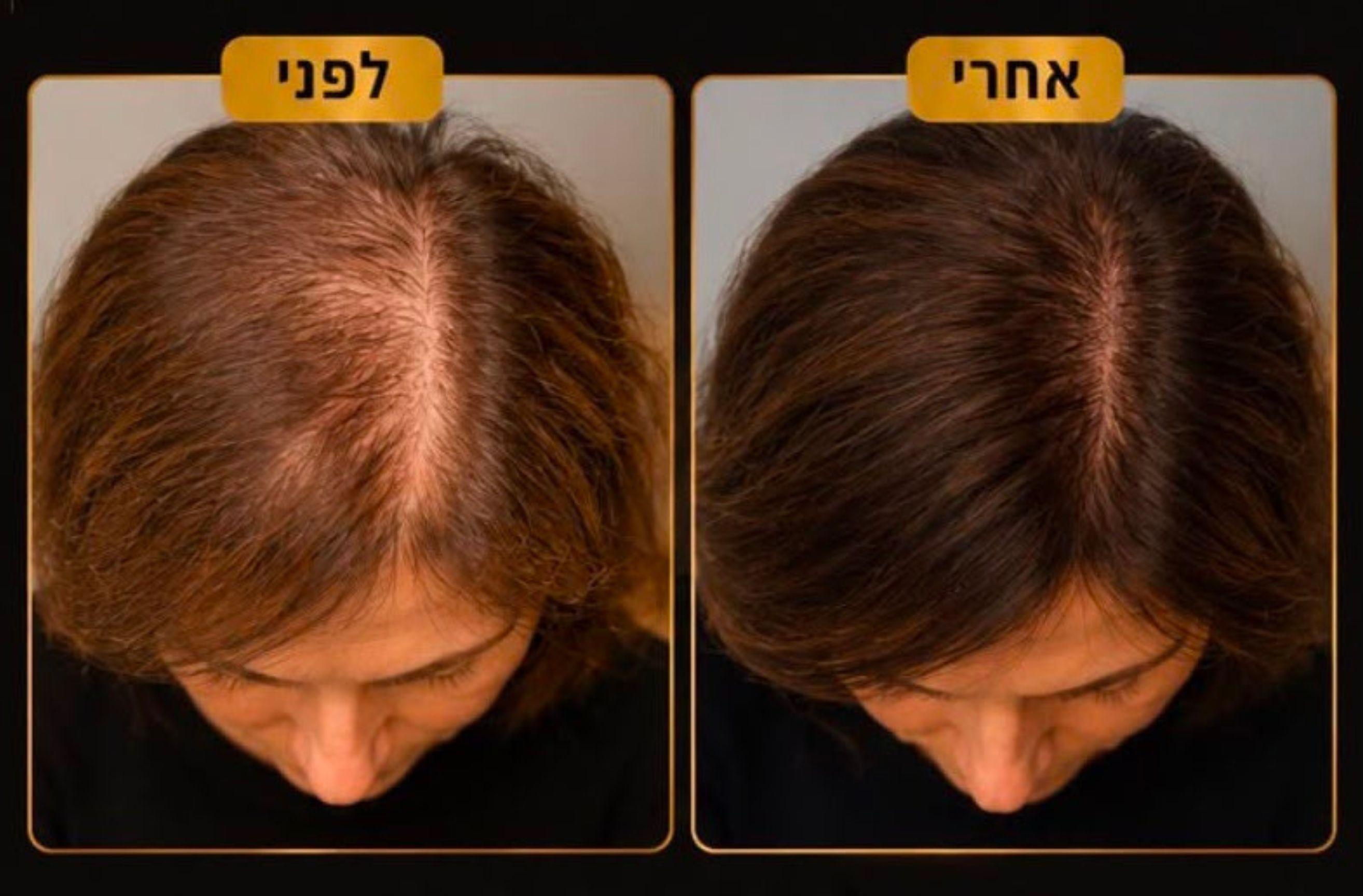 פדחת לשיער – הדגמת תוצאה במראה טבעי